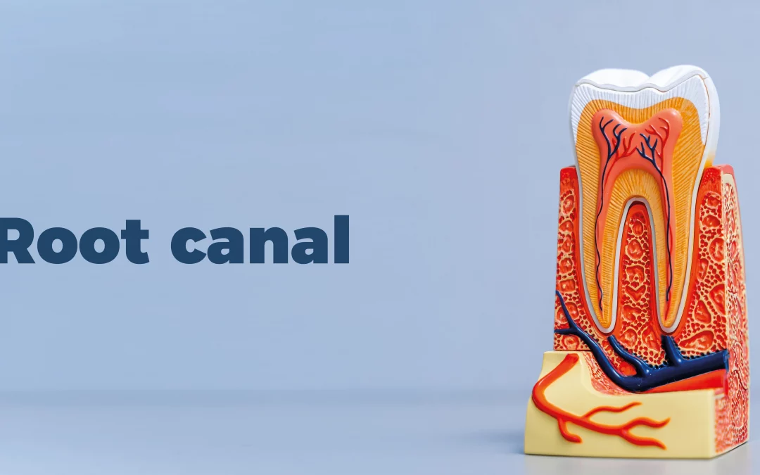 Root-Canal