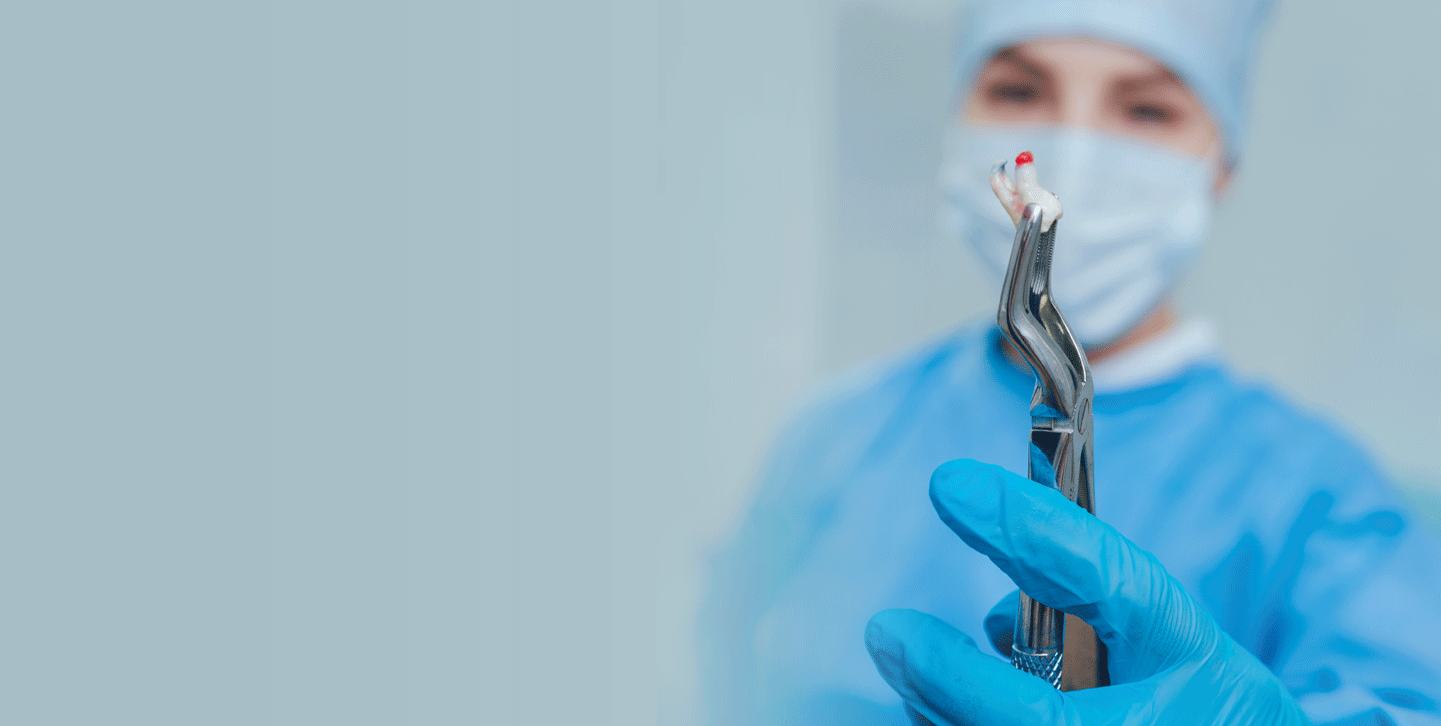 خلع الأسنان